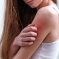 What is the difference between paresthesia and neuropathy?