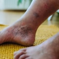 What is the first stage of neuropathy?