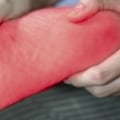 What are the five stages of diabetic neuropathy?