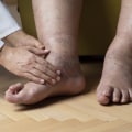What is the prescription cream for neuropathy in the feet?