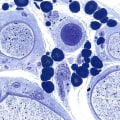 What is the number one medical condition that causes neuropathy?