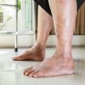 What is the earliest sensation loss in diabetic neuropathy?