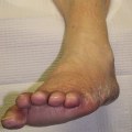 Can you repair nerve damage from diabetes?