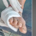 How long can one live with diabetic neuropathy?