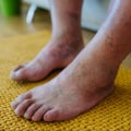 What triggers neuropathy in the feet?