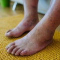 Does diabetic neuropathy ever go away?