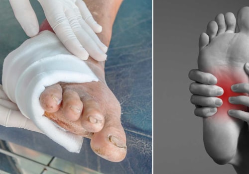 At what stage of diabetes does neuropathy start?