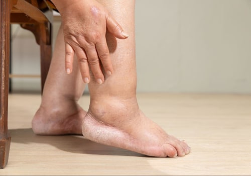 How long can a person live with neuropathy?