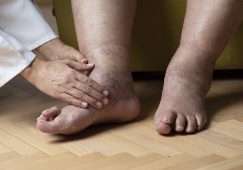 What is the prescription cream for neuropathy in the feet?