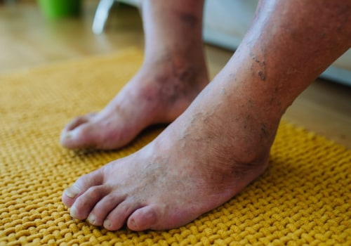 Is diabetic neuropathy permanent?