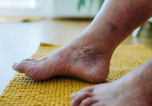 What does early diabetic neuropathy feel like?
