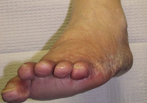 Can you repair nerve damage from diabetes?