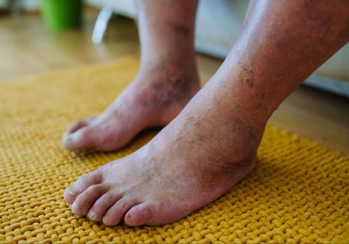 What triggers neuropathy in the feet?