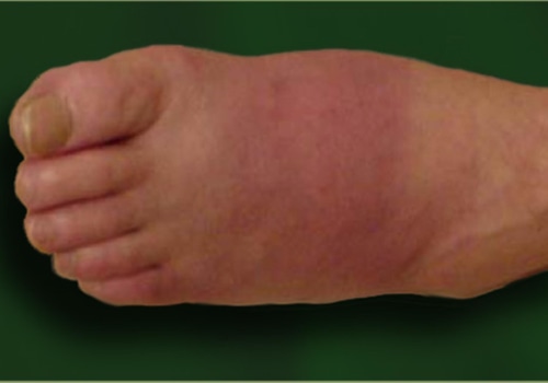 What is stage 1 diabetic neuropathy?