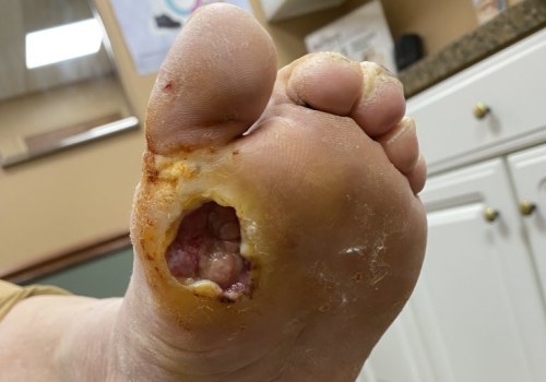 Will diabetic neuropathy ever go away?