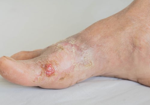 How to stop nerve damage due to diabetes?